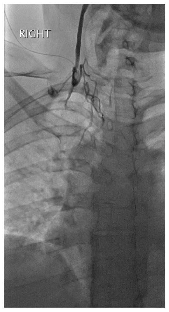 This diagnostic fluoroscopic image displays a right internal jugular venogram obtained via micropuncture access. The radiograph reveals an abrupt termination of contrast medium flow within the proximal right internal jugular vein, signifying a complete vascular occlusion. Distal to the site of obstruction, there is a total absence of contrast filling in the expected anatomical course of the vein toward the superior vena cava. To compensate for the blockage, multiple small, tortuous collateral vessels are visible, branching out to bypass the occluded segment. The underlying skeletal anatomy, including the cervical and upper thoracic vertebrae, clavicle, and ribs, serves as dense radio-opaque landmarks for spatial orientation. This image is clinically significant for demonstrating venous thrombosis or mechanical occlusion in the neck vasculature, illustrating the development of collateral circulation in response to chronic or acute venous obstruction.