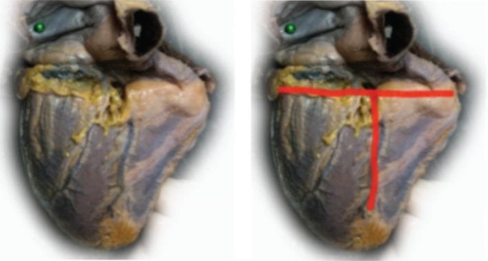 This clinical photograph shows a diaphragmatic (inferior) view of a human heart specimen. The image is presented in a side-by-side comparison format: the left panel displays the original gross specimen, while the right panel includes red annotations highlighting key anatomical landmarks. The cardiac surface exhibits a mottled reddish-brown myocardium with visible yellow epicardial adipose tissue concentrated along the sulci. The annotations demonstrate a 'T-shaped' intersection of major grooves: a horizontal red line identifies the coronary sulcus (atrioventricular groove), and a perpendicular vertical red line identifies the posterior interventricular sulcus. These landmarks delineate the boundaries between the atria and ventricles, and between the left and right ventricles, respectively. The educational focus is on the spatial orientation of cardiac surface anatomy and the identification of major coronary pathways as they appear from an inferior perspective.