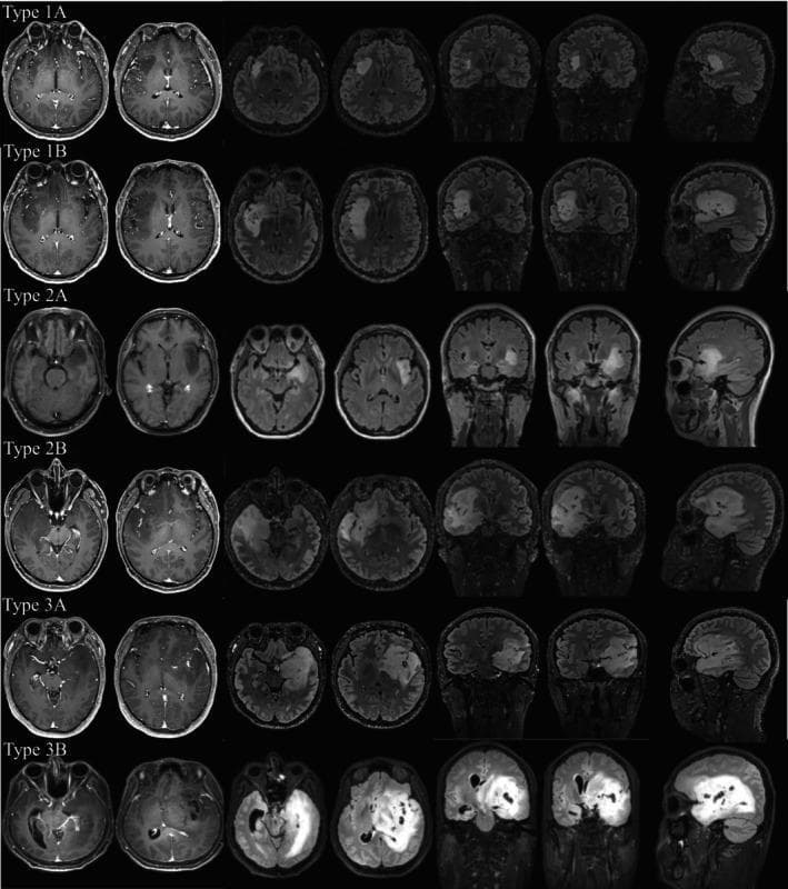 This diagnostic image composite presents a neurological classification system for gliomas based on tumor spread and anatomical involvement, organized into six types: 1A, 1B, 2A, 2B, 3A, and 3B. Each row displays axial, coronal, and sagittal MRI views, primarily utilizing T1-weighted and T2/FLAIR sequences to demonstrate lesion morphology.
Type 1A shows a localized hyperintense lesion restricted to the insular cortex. Type 1B displays extension into the orbitofrontal cortex or temporal pole. The Type 2 category focuses on medial temporal involvement: 2A involves peri-hippocampal structures (amygdala and parahippocampal gyrus), while 2B shows direct invasion of the hippocampus. Type 3 represents deep structure involvement: 3A demonstrates invasion into the internal capsule, and 3B shows the most extensive spread, involving both the internal capsule and the thalamus. The images highlight the progression from localized cortical lesions to deep white matter and nuclear gray matter invasion, serving as a radiological tool for preoperative staging and surgical planning.