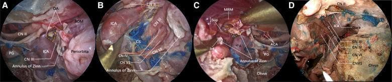 This composite of four endoscopic clinical photographs (A–D) provides an endonasal perspective of the sphenoid sinus lateral wall, specifically focusing on the anatomical landmarks of the optic strut triangle and the cavernous sinus (CS). Panel A demonstrates the relationship between the optic nerve (CN II), the internal carotid artery (ICA), and the ophthalmic artery (OA) following bone removal of the optic strut. Panel B illustrates the vertical spatial arrangement of cranial nerves emerging from the medial wall of the cavernous sinus: from superior to inferior, the oculomotor nerve (CN III), trochlear nerve (CN IV), ophthalmic nerve (CN V1), and abducent nerve (CN VI) are identified. Panel C shows the division of the oculomotor nerve into superior (Sup) and inferior (Inf) branches near the medial rectus muscle (MRM) and Annulus of Zinn. Panel D provides a broader view of the parasellar region, highlighting the course of CN III, IV, VI, and V1 relative to the ICA, clivus, and surrounding dura. These images illustrate key neurovascular relationships critical for transnasal endoscopic decompression of the orbital apex and superior orbital fissure.