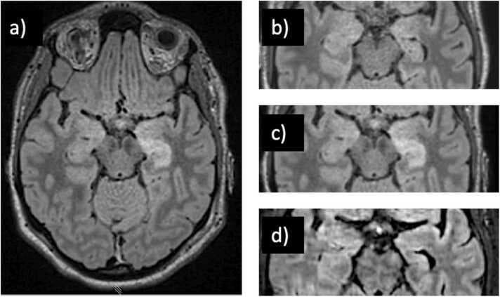 This diagnostic image set consists of axial brain MRI scans using Fluid-Attenuated Inversion Recovery (FLAIR) sequences, illustrating the progression of anti-NMDA receptor encephalitis. Image (a) is a whole-brain FLAIR view showing a prominent area of hyperintense signal and swelling (enlargement) in the left hippocampus, compared to the normal contralateral side. Images (b), (c), and (d) provide a longitudinal comparison of the medial temporal lobe. Frame (b) shows the initial baseline MRI with no discernible abnormalities. Frame (c), taken at day 5, demonstrates the development of distinct hyperintensity and edema within the left hippocampus, characteristic of the acute inflammatory phase of autoimmune encephalitis. Frame (d) illustrates a long-term follow-up after immunotherapy (corticosteroids and plasmapheresis); it shows a reduction in the hyperintense signal but reveals secondary structural changes, specifically left hippocampal atrophy evidenced by volume loss. The images serve as an educational timeline for monitoring inflammatory brain disease, treatment response, and subsequent chronic sequelae like focal atrophy.