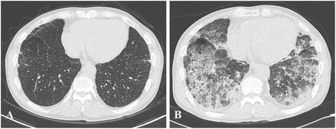This diagnostic image consists of two axial low-dose chest computed tomography (LDCT) scans comparing chronic baseline lung disease with an acute pulmonary event. Image A (baseline) shows numerous, diffuse, small calcified nodular infiltrations distributed throughout both lung fields, characteristic of pneumoconiosis. Additional findings include minimal subpleural septal thickening and fine reticulations in the right middle lobe and both lower lobes, alongside calcified lymphadenopathy in the mediastinal and hilar regions. Image B (at admission) demonstrates a significant progression in pathology, featuring multifocal patchy areas of consolidation and diffuse ground-glass opacities (GGO) bilaterally. These acute findings are clinically suggestive of extensive pneumonia, pulmonary edema, or alveolar hemorrhage superimposed on the underlying chronic interstitial disease. The comparison highlights the transition from a stable nodular pattern to acute, severe parenchymal opacification, relevant for pulmonology and radiology education regarding complications in occupational lung disease.