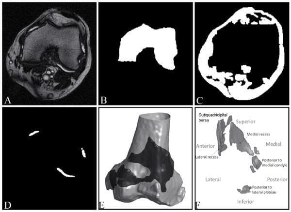 This figure illustrates the multi-stage computational segmentation process of synovial fluid in a patient with knee osteoarthritis using MRI. Panel (A) shows a source axial T2-weighted MRI slice of the knee joint, demonstrating anatomical structures including the femur, patella, and surrounding soft tissues with varying signal intensities. The joint effusion appears as high-intensity (bright) signals within the joint space. Panels (B), (C), and (D) present intermediate binary masks generated during segmentation: (B) masks the femur, (C) identifies other non-fluid structures such as patellar fat pads and cortical bone, and (D) isolates the synovial effusion as discrete white regions. Panels (E) and (F) provide 3D reconstructions of the synovial fluid volume. (E) shows the spatial relationship of the joint effusion (dark grey) as it wraps around the distal femur (light grey). (F) provides a labeled 3D map of the effusion, identifying specific anatomical compartments including the subquadricipital bursa, medial and lateral recesses, and posterior fluid pockets. This resource demonstrates the application of medical imaging processing to quantify joint inflammation and effusion volume.