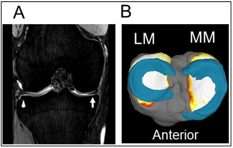 This composite image illustrates the normal anatomy of the knee menisci using two different Magnetic Resonance Imaging (MRI) perspectives. Figure A presents a coronal MRI cross-section of a right knee, where the medial meniscus (MM) and lateral meniscus (LM) appear as low-signal (dark), wedge-shaped fibrocartilaginous structures situated within the joint space between the femoral condyles and the tibial plateau. The medial meniscus is indicated by a white arrow, and the lateral meniscus is marked with a white arrowhead. Figure B displays a 3D MRI reconstruction of the same structures viewed from a superior perspective. In this 3D model, the menisci are color-coded in teal blue, highlighting their characteristic C-shaped (medial) and more circular (lateral) morphology sitting atop the gray-shaded tibial plateau. The 'Anterior' label provides orientation. These images serve as an educational baseline for identifying healthy meniscal tissue and its positioning, which is critical for evaluating pathologies such as meniscal tears or extrusions that contribute to the development of osteoarthritis.
