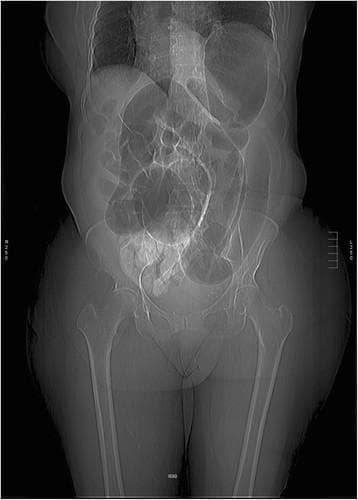 This abdominal radiograph (X-ray) demonstrates a classic presentation of sigmoid volvulus, a form of large bowel obstruction. The primary finding is a massively dilated, air-filled loop of the sigmoid colon that occupies the majority of the abdominal cavity. This loop exhibits the characteristic 'coffee bean' sign, with a vertical dense line (the 'crease' of the bean) formed by the adjacent walls of the twisted bowel loop. The distended colon extends from the pelvis toward the upper abdominal quadrants, significantly displacing other abdominal contents. The absence of gas in the distal rectum is consistent with a complete obstruction. Visualized skeletal structures, including the lumbar spine, bony pelvis, and proximal femurs, appear anatomically normal without evidence of fracture or related deformity. This imaging is critical for diagnosing acute large bowel obstruction in elderly or debilitated patients and necessitates urgent clinical intervention, such as endoscopic decompression or surgical repair.