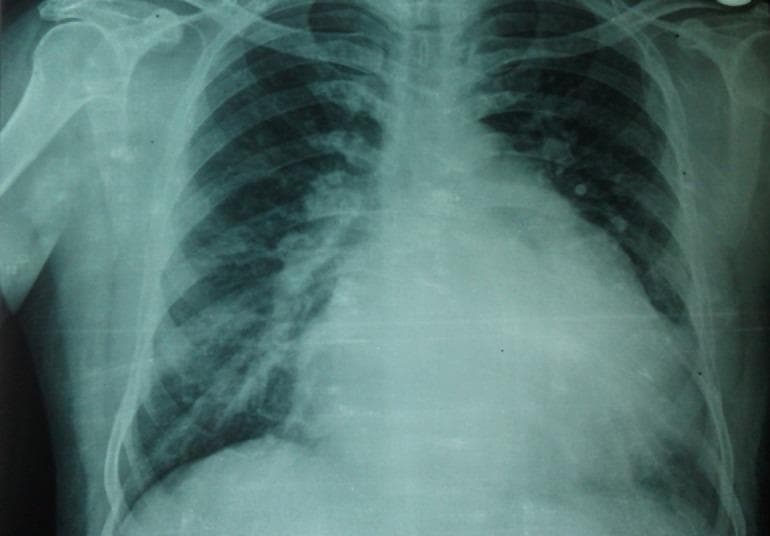 This diagnostic image is a posterior-anterior (PA) chest X-ray demonstrating significant cardiomegaly and pulmonary vascular congestion. The cardiac silhouette is markedly enlarged, occupying more than 50% of the thoracic diameter. Key radiographic findings include straightening of the left heart border and a double density sign, highly suggestive of left atrial enlargement. The pulmonary vasculature appears prominent, particularly in the perihilar regions, with associated interstitial haziness and increased pulmonary markings indicating pulmonary overflow or venous congestion. These findings are clinically relevant for evaluating valvular heart disease, such as mitral stenosis, or congenital defects like atrial septal defect (ASD) that lead to chronic volume overload. The image serves as an educational example of how chronic cardiac remodeling manifests radiographically, highlighting the relationship between left-sided heart disease and secondary pulmonary vascular changes.