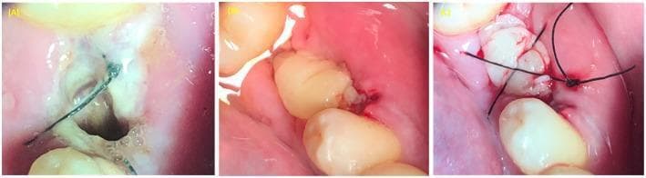 A series of three clinical intraoral photographs (A-C) illustrating the treatment of alveolar osteitis (dry socket) using Platelet-Rich Plasma (PRP) for tissue regeneration. Image (A) shows an empty, dark alveolar socket post-extraction with initial marginal suturing and visible inflammatory exudate. Image (B) demonstrates the application of autologous Platelet-Rich Plasma (PRP) as a pale, gel-like material filling the extraction socket to promote healing. Image (C) illustrates the final stabilization phase, where a non-resorbable black figure-8 suture is placed over the socket to secure the PRP graft and facilitate primary closure. This clinical progression highlights regenerative techniques in oral and maxillofacial surgery to enhance soft and hard tissue healing in compromised extraction sites.