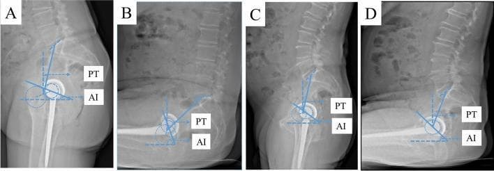 This set of four lateral radiographs (labeled A-D) illustrates the dynamic relationship between pelvic orientation and total hip arthroplasty (THA) component position in patients with varying spinopelvic mobility. Images A and B depict a patient with spinopelvic hypermobility in standing (A) and sitting (B) positions. Note the significant change in pelvic tilt (PT) and acetabular anteinclination (AI) when moving from standing to sitting, characterized by a more vertical cup orientation in the seated position. Images C and D depict a patient with spinopelvic stiffness in standing (C) and sitting (D) positions. In the stiff patient, the pelvic orientation remains relatively fixed, resulting in a more horizontal cup position in the sitting phase compared to the hypermobile patient. Key measurements shown include Pelvic Tilt (PT), the angle between a vertical line and a line from the center of the femoral head to the midpoint of the sacral endplate, and Anteinclination (AI), representing a combined parameter of cup anteversion and inclination. These images demonstrate how limited lumbar and pelvic movement (stiffness) can adversely affect functional component position during postural transitions.
