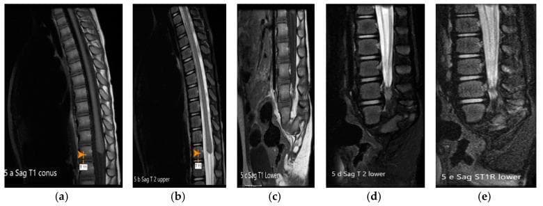 This diagnostic image set consists of sagittal MRI sequences (T1, T2, T1 Fat-Suppressed, and STIR) of the spine, illustrating features of Caudal Regression Syndrome (CRS) Type 1. The conus medullaris is high-set, appearing truncated and nodular, terminating prematurely at the level of the intrapedicular T11 vertebra. The distal spinal canal demonstrates a thickened cauda equina and a sagittal cleft in the thecal sac. The lower spine shows significant developmental anomalies, including a rudimentary, dysgenetic sacrum with a median sagittal cleft and absence of the coccyx. Additionally, rudimentary pelvic apophyses are visible. The STIR sequence (e) highlights increased signal intensity in the region of the truncated conus, while the T1-weighted images (a, c) best define the morphology of the osseous defects and the blunt termination of the cord. This visual documentation serves as a classic educational example of terminal spinal cord dysgenesis and sacral hypoplasia, essential for distinguishing between types of caudal regression in pediatric neuroradiology.