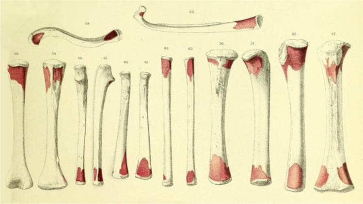 This historical anatomical diagram, credited to Albert Kölliker, illustrates the zones of periosteal resorption on various human long bones, including the femur, tibia, humerus, and clavicle. The illustration depicts thirteen labeled bones (numbered 46–66) showcasing different morphologies, from thick weight-bearing bones to slender and curved structures. The primary educational focus is the visual representation of bone remodeling processes during growth. Distinctive red-shaded areas mark specific regions of bone resorption, which are predominantly localized at the epiphyses and metaphyses. These red zones vary in size and shape, appearing as irregular patches or concentrated caps at the bone ends, while the mid-diaphyses remain white. This diagram historically served to prove the osteogenetic function of the periosteum and the necessity of surface resorption for maintaining appropriate bone shape and proportion during longitudinal and appositional growth. It is a critical visual aid for understanding skeletal development and the cellular activities of osteoclasts in physiological bone modeling.