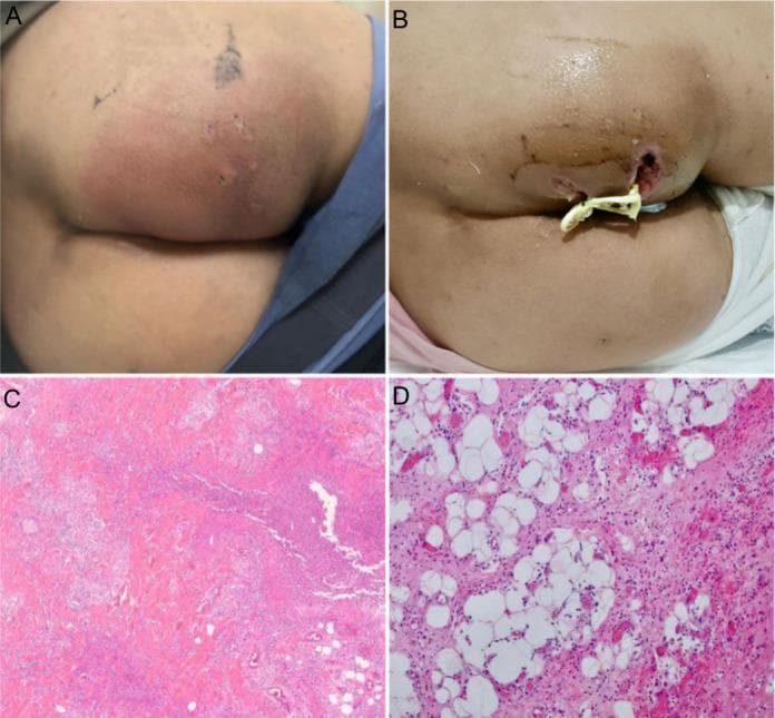 This composite image illustrates the clinical presentation, surgical management, and histopathology of a perianal abscess. (A) A clinical photograph shows a large, localized, erythematous swelling in the perianal region. The skin is notably red, tense, and bulging, indicating acute inflammation and an underlying fluctuant mass. (B) A subsequent photograph depicts the post-surgical status following incision and drainage. An open wound with irregular margins is visible, with a Penrose drain or surgical packing inserted into the cavity to facilitate the evacuation of purulent material and prevent premature closure. (C, D) Hematoxylin and eosin (H&E) stained histopathological sections at 40x and 200x magnification, respectively, show a dense inflammatory infiltrate. There is a prominent influx of neutrophils and lymphocytes into the dermal appendages and fibrous adipose tissue. The images demonstrate active abscess formation characterized by tissue necrosis and a heavy polymorphonuclear leukocyte presence, confirming the acute infective process within the perianal soft tissue.