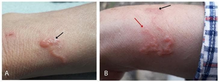 This composite clinical photograph displays cutaneous larva migrans (CLM) on the dorsum of the right forearm. Image A depicts the initial presentation of a characteristic serpiginous (snake-like) skin lesion. The tract is erythematous, elevated, and shows evidence of vesiculobullous formation with small vesicles along the inflammatory path. A black arrow indicates the presumed site of larval penetration where the inflammation is comparatively less intense. Image B illustrates the lesion's progression and response to ivermectin treatment. It shows the continued serpiginous path with varying degrees of erythema and edema. A red arrow marks the advancing, more inflamed endpoint of the burrowing larva, while the black arrow points toward the older, resolving portion of the tract. The visual findings are pathognomonic for hookworm-related cutaneous larva migrans (Hr-CLM), often caused by Ancylostoma species. This educational material is suitable for dermatology and infectious disease studies, demonstrating the clinical morphology of parasitic skin infestations and their migratory patterns.