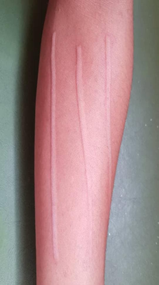 Clinical photograph of a left forearm demonstrating dermatographism (skin writing), a form of physical urticaria. The image shows three distinct, raised, linear wheals (urticarial lesions) running longitudinally along the forearm. These markings are characteristically pale or erythematous with well-defined borders against the surrounding skin. The appearance is a classic representation of the triple response of Lewis, specifically the localized edema (wheal) that occurs in response to firm stroking or mechanical pressure on the skin. This finding is often associated with mast cell degranulation and histamine release in sensitive individuals. The photograph serves as an educational example for diagnosing physical urticarias and understanding the cutaneous manifestations of hyperreactivity in the dermatology and allergy/immunology domains.