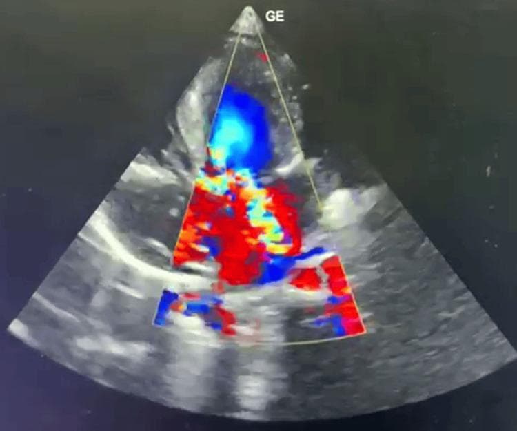 This diagnostic image is a 2D color Doppler echocardiogram illustrating Hypertrophic Obstructive Cardiomyopathy (HOCM). The ultrasound shows significant asymmetrical septal hypertrophy, which leads to the narrowing of the Left Ventricular Outflow Tract (LVOT). The color Doppler overlay reveals complex, turbulent blood flow patterns: a prominent blue jet at the top indicating flow away from the transducer, and mosaic red-yellow regions in the mid-section suggestive of high-velocity flow and significant pressure gradients (96 mmHg). These findings are consistent with dynamic outflow obstruction and associated moderate-to-severe mitral regurgitation (MR). Additional visualized features include valvular and supravalvular pulmonary stenosis and a prominent eustachian valve. This clinical image is a primary educational resource for identifying the anatomical and hemodynamic markers of pediatric HOCM, specifically demonstrating the relationship between septal thickening and turbulent outflow.