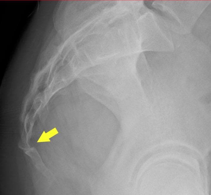 This diagnostic image is a lateral plain radiograph of the sacrococcygeal region of the human spine. The image displays the lower sacral vertebrae and the articulating coccygeal segments. A yellow arrow points specifically to the sacrococcygeal junction, highlighting a ventral (anterior) subluxation of the coccyx. The coccygeal segments are displaced forward relative to the distal sacrum, indicating a disruption of the normal pelvic curve. This radiological finding is clinically significant for the diagnosis of coccydynia (tailbone pain), which may be associated with postpartum trauma or direct injury. The image serves as an educational example of sacrococcygeal malalignment and traumatic orthopedic displacement in a clinical setting.