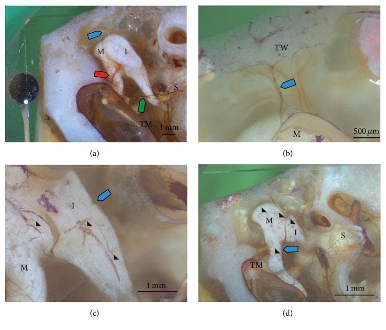 Reflected light microscopic images of the human middle ear auditory ossicles, displaying the anatomy and microvasculature of the malleus (M), incus (I), and stapes (S). The images highlight the structural relationships within the tympanic cavity, including the tympanic membrane (TM) and tympanic wall (TW). Colored arrows identify key arterial branches: the blue and red arrows mark the anterior tympanic artery pathways through the superior malleolar ligament and anterior malleolar plication, while the green arrow indicates the posterior tympanic artery crossing the incudostapedial joint. High-magnification views (c and d) utilize arrowheads to demonstrate the intricate intraosseous blood vessel system penetrating the ossicles via nutrient foramina. These sections differentiate between vascularized bone and avascular cartilage regions (indicated by asterisks). This educational visual illustrates middle ear micro-anatomy and the primary blood supply sources—the anterior and posterior tympanic arteries—essential for understanding ossicular physiology and surgical pathology in otolaryngology.
