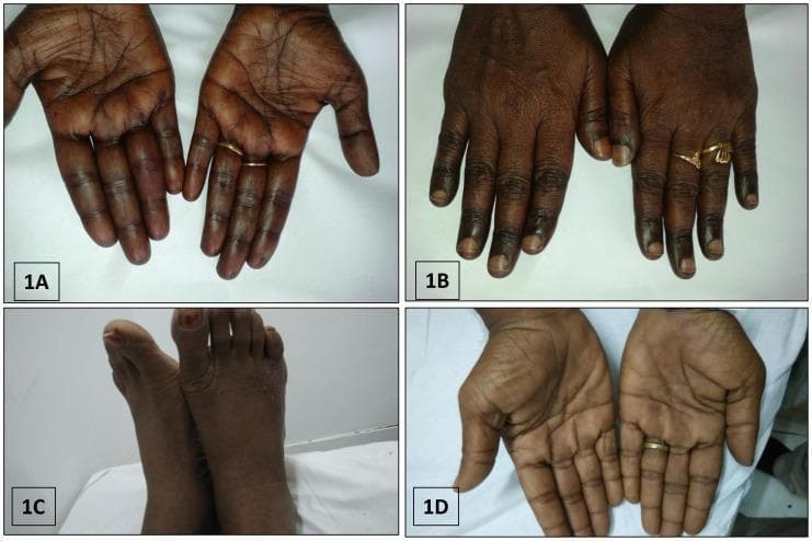 This composite of clinical photographs illustrates various patterns of cutaneous hyperpigmentation associated with megaloblastic anemia due to Vitamin B12 deficiency. Image 1A and 1D display the palmar surfaces of the hands, showing diffuse, brownish-black hyperpigmentation with prominent accentuation along the palmar creases. Image 1B focuses on the dorsal aspect of the hands, highlighting localized brownish-black pigmentation specifically over the knuckle pads and phalangeal joints. Image 1C depicts the dorsal aspect of the feet, exhibiting a similar diffuse, dusky, brownish-black discoloration across the skin surface. These dermatological findings are classic external markers of severe B12 deficiency and often present alongside systemic symptoms like pancytopenia and macrocytosis. The collection serves as an educational tool for recognizing the cutaneous manifestations of nutritional deficiencies and metabolic disorders in hematology and dermatology.