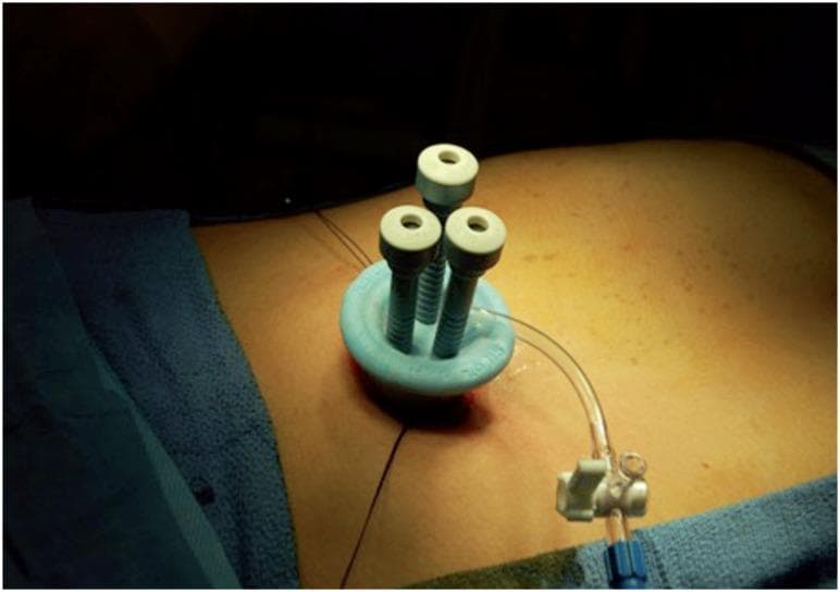 This clinical photograph demonstrates an intraoperative view of a Single Incision Laparoscopic Surgery (SILS) port placed at the patient's umbilicus. The central apparatus is a specialized multi-channel access device featuring a blue, flexible thermoplastic elastomer base that creates an airtight seal against the abdominal wall. Three vertical cannulas with white valvular caps are integrated into the port, allowing for the simultaneous insertion of a laparoscope and two surgical instruments through a single umbilical incision. A clear insufflation tube is connected to the side of the port, facilitating the maintenance of pneumoperitoneum during the Laparoendoscopic Single-site Surgery (LESS). Visible landmarks include the surrounding abdominal skin, surgical marking lines, and blue sterile surgical drapes in the periphery. This image illustrates a minimally invasive surgical technique used for procedures such as nephrectomy or appendectomy, prioritizing improved cosmesis and potentially reduced postoperative pain compared to traditional multi-port laparoscopy.