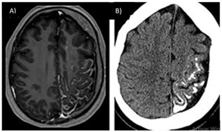 This dual-panel diagnostic image displays characteristic findings of Sturge-Weber syndrome (SWS) in the brain. Image A is a contrast-enhanced axial T1-weighted MRI showing intense, curvilinear leptomeningeal enhancement over the left cerebral hemisphere. The enhancement follows the pial surface of the gyri and sulci, consistent with a leptomeningeal angioma. Image B is a non-contrast axial CT scan of the same patient, revealing extensive gyriform calcifications (the 'tram-track' sign) within the left cortex, appearing as hyperdense, serpentine lines. Both modalities demonstrate secondary structural changes, including ipsilateral cortical atrophy and volume loss of the left hemisphere compared to the right. These findings illustrate the classic neuroimaging triad of SWS: leptomeningeal vascular malformation, intracranial calcification, and associated cerebral atrophy. This material is highly relevant for medical education in neurology, radiology, and pediatrics for the identification of phakomatoses and neurocutaneous syndromes.