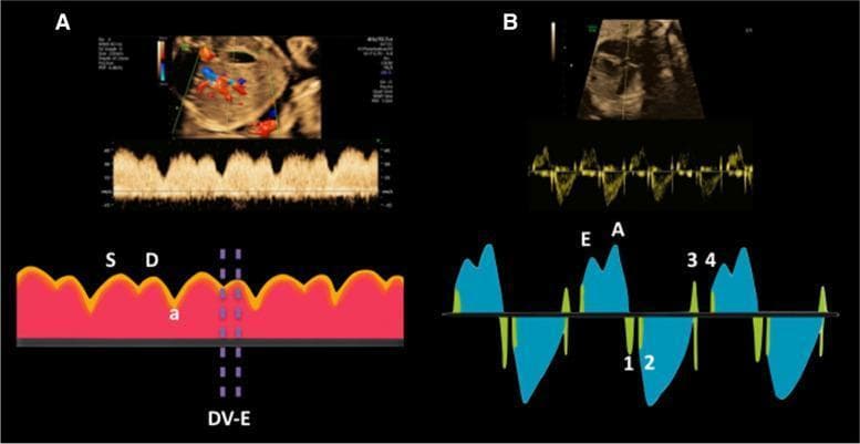 This composite educational graphic illustrates two methods for fetal cardiovascular assessment using spectral Doppler ultrasound. Panel A demonstrates Ductus Venosus (DV) Doppler waveforms. The pulsed-wave Doppler trace and accompanying schematic identify key components: the systolic wave (S), diastolic wave (D), and atrial contraction wave (a). A vertical dashed marker indicates the measurement of the early diastolic filling time (DV-E), representing the interval between ventricular end-systole and the peak of the D-wave. Panel B depicts the Left Myocardial Performance Index (LV-MPI) obtained from a fetal heart. The waveform shows characteristic valve clicks used for timing intervals: mitral valve closure (1), aortic valve opening (2), aortic valve closure (3), and mitral valve opening (4). The schematic also highlights the early (E) and late/atrial (A) diastolic inflow peaks. These markers allow for the calculation of isovolumetric contraction time (ICT), isovolumetric relaxation time (IRT), and ejection time (ET), providing a global assessment of fetal cardiac function. The image serves as a reference for standardized fetal Doppler measurement techniques.