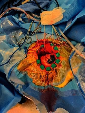 Clinical photograph of an intraoperative brain biopsy procedure. The image shows a prepared surgical field on the scalp, demarcated by sterile blue drapes and a clear adhesive incise drape. A circular craniotomy site is visible, with the scalp edges retracted using green Raney clips and sutures held by several hemostats/clamps. Within the surgical opening, the underlying cerebral tissue is exposed, revealing a prominent, deeply pigmented (blackish-brown) lesion localized to a gyrus, which is suspicious for metastatic melanoma. Moderate bleeding is observed around the incision margins, with blood tracking over the yellow-prepped scalp and onto the surrounding drapes. Surgical adjuncts visible include a clear suction tube, a saturated gauze sponge, and various cables for monitoring or cautery. This image demonstrates the visual presentation of a pigmented intracranial metastasis during neurosurgical intervention.