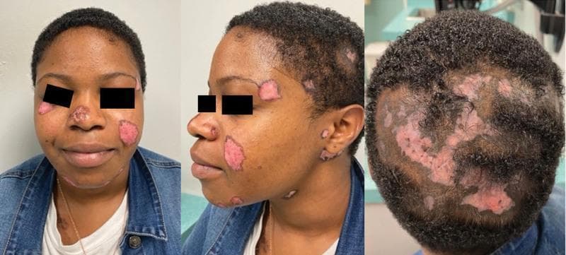 A composite of three clinical photographs showing the face and scalp of a patient with chronic cutaneous lupus erythematosus (CCLE), specifically discoid lupus erythematosus (DLE). The frontal and lateral views of the face demonstrate multiple well-demarcated, erythematous, atrophic patches of varying sizes. These lesions are located on the nasal bridge, cheeks, temples, jawline, and ears. Key morphological features include central atrophy and scarring with peripheral hyperpigmentation and active erythema. The posterior view of the scalp reveals significant multifocal cicatricial (scarring) alopecia. The hair loss areas directly correspond to the presence of large, irregular, confluent erythematous and depigmented patches. The scalp lesions show a complete loss of follicular ostia within the atrophic centers, characteristic of permanent hair loss in DLE. This visual series illustrates the classic distribution and morphology of discoid rash affecting both glabrous skin and hair-bearing areas in an adult patient.
