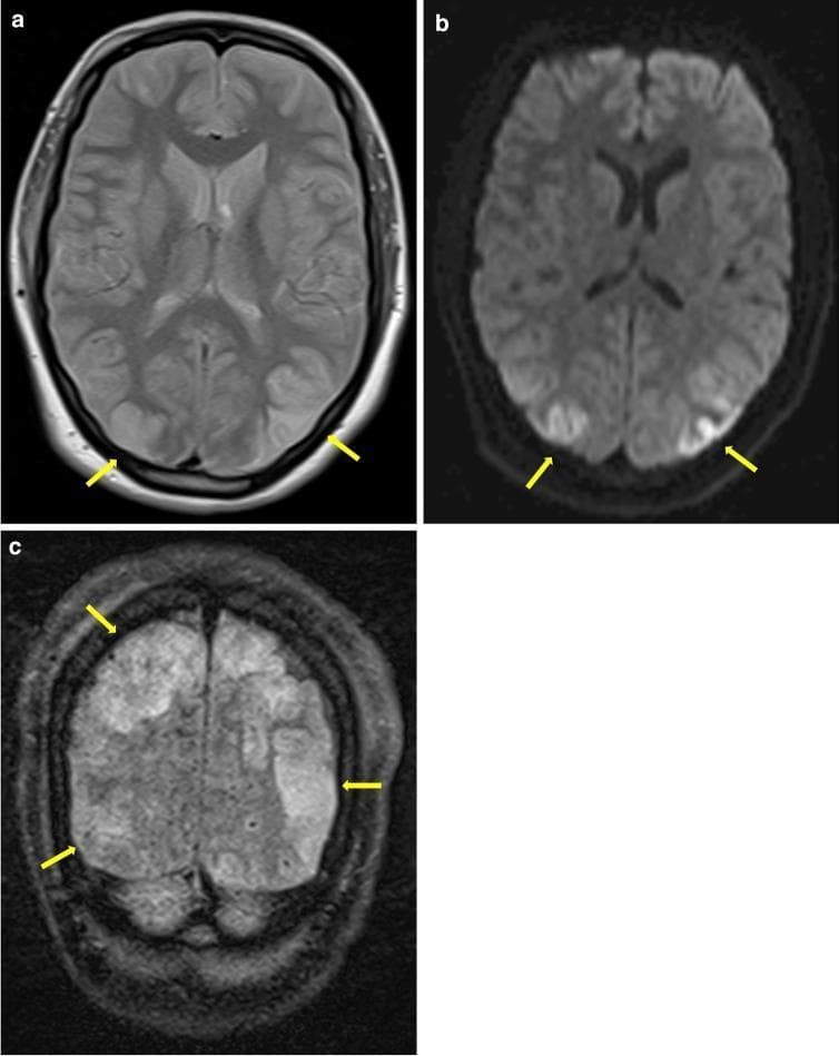 Diagnostic neuroimaging panel consisting of three MRI sequences demonstrating Posterior Reversible Encephalopathy Syndrome (PRES). Image (a) is a transverse Proton-Density-weighted (PDw) MRI showing bilateral, symmetrical hyperintense signal alterations in the posterior regions of the brain. Image (b) is a transverse Diffusion-Weighted Imaging (DWI) sequence, which highlights these same areas as bright hyperintensities, indicated by yellow arrows. Image (c) is a coronal Fluid-Attenuated Inversion Recovery (FLAIR) scan providing a different perspective of the bi-occipital involvement. The hyperintensities are predominantly localized to the occipital lobes, involving both the cortical ribbon and the subcortical white matter. This pattern is characteristic of vasogenic edema rather than cytotoxic infarction, especially when lacking ADC hypointensities. These findings are clinically relevant as common manifestations of PRES, often seen in the context of Reversible Cerebral Vasoconstriction Syndrome (RCVS), pre-eclampsia, or hypertensive emergencies, representing a breakdown of cerebral autoregulation in the posterior circulation territories.