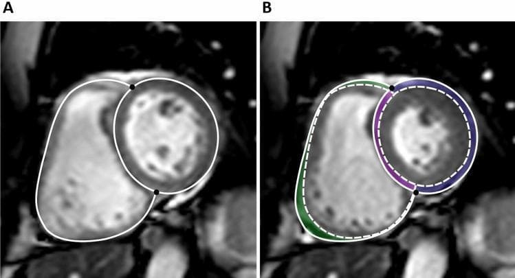 This diagnostic image consists of two panels (A and B) showing Cardiac Magnetic Resonance (CMR) in a short-axis view of the heart. The image demonstrates the quantitative assessment of stroke volume (SV) components through ventricular segmentation. Panel A depicts the heart at end diastole, with solid white lines outlining the epicardial borders of the left ventricle (LV) and right ventricle (RV); black dots indicate the RV insertion points. Panel B illustrates the end-systolic state, featuring dashed white lines for the end-systolic epicardial borders superimposed on the end-diastolic contours. Color-coded regions quantify localized contributions to stroke volume: the purple area between RV insertion points represents the septal contribution; the green area represents the lateral wall contribution of the RV; and the blue area represents the lateral wall contribution of the LV. This visual is used to distinguish between septal and lateral myocardial shortening and their respective roles in ventricular pump function, relevant for cardiovascular physiology and advanced cardiac imaging education.