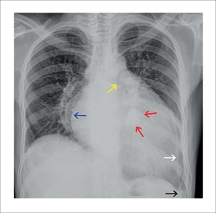 Posteroanterior (PA) chest radiograph demonstrating significant cardiomegaly and specific signs of multi-chamber enlargement, particularly the left atrium. Key findings include the 'double density' sign (blue arrow) along the right heart border and elevation of the left mainstem bronchus (yellow arrow), both classic radiographic indicators of left atrial enlargement. A well-defined, oval hyperdense lesion (red arrows), approximately 3.5 cm x 2.0 cm, is visible projected over the cardiac silhouette near the expected location of the mitral valve, consistent with caseous calcification of the mitral annulus (CCMA). Additionally, the left costophrenic angle is obliterated (black arrow), suggesting a small pleural effusion, and a linear calcification is noted along the peripheral left hemithorax (white arrow), possibly representing pleural calcification. The overall cardiac configuration, including a straightened left heart border and enlarged silhouette, is highly suggestive of advanced valvular heart disease, such as rheumatic heart disease, resulting in chronic heart failure.