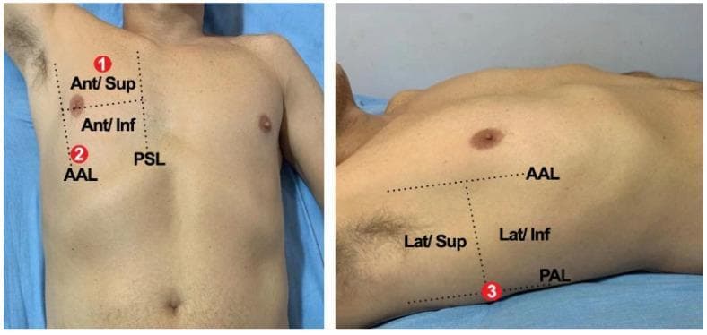 Two clinical photographs demonstrate a standardized lung auscultation protocol for ICU patients, specifically targeting the right lung. The images show a male torso with anatomical landmarks and auscultation zones delineated by dotted grid lines and numeric labels.
The anterior view (left image) identifies Point 1 in the 'Ant/Sup' (Anterior/Superior) and 'Ant/Inf' (Anterior/Inferior) regions, bounded medially by the Parasternal Line (PSL) and laterally by the Anterior Axillary Line (AAL). Point 2 is situated more inferiorly along the AAL.
The lateral view (right image) shows Point 3, located posteriorly to the AAL and near the Posterior Axillary Line (PAL). This region is divided into 'Lat/Sup' (Lateral/Superior) and 'Lat/Inf' (Lateral/Inferior) zones.
These anatomical markers serve as a clinical guide for healthcare providers to ensure consistent positioning of the stethoscope during physical examinations, particularly for monitoring respiratory conditions such as COVID-19 in a critical care setting. The visual aid emphasizes the importance of using specific axillary and parasternal landmarks to capture sounds from the upper and lower lobes of the right lung.
