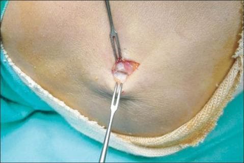 This clinical photograph captures an intraoperative view of a surgical procedure for lateral epicondylitis (tennis elbow) through a minimal skin incision. Two small toothed retractors are utilized to hold the wound edges open, exposing the origin of the extensor carpi radialis brevis (ECRB) muscle near the lateral epicondyle of the humerus. The exposed tendon tissue exhibits clear signs of tendinosis, characterized by a loss of normal glistening white appearance, irregular texture, and areas of brownish-gray discoloration. Visible pathology includes focal degeneration, scarring, and evidence of friable granulation tissue, indicating chronic repetitive microtrauma and a failed healing response. The image demonstrates the surgical approach for debriding degenerative tendon tissue and serves as an educational reference for orthopedic surgeons and residents studying the macroscopic presentation of chronic tendinopathy and the Nirschl surgical technique for lateral epicondylitis.