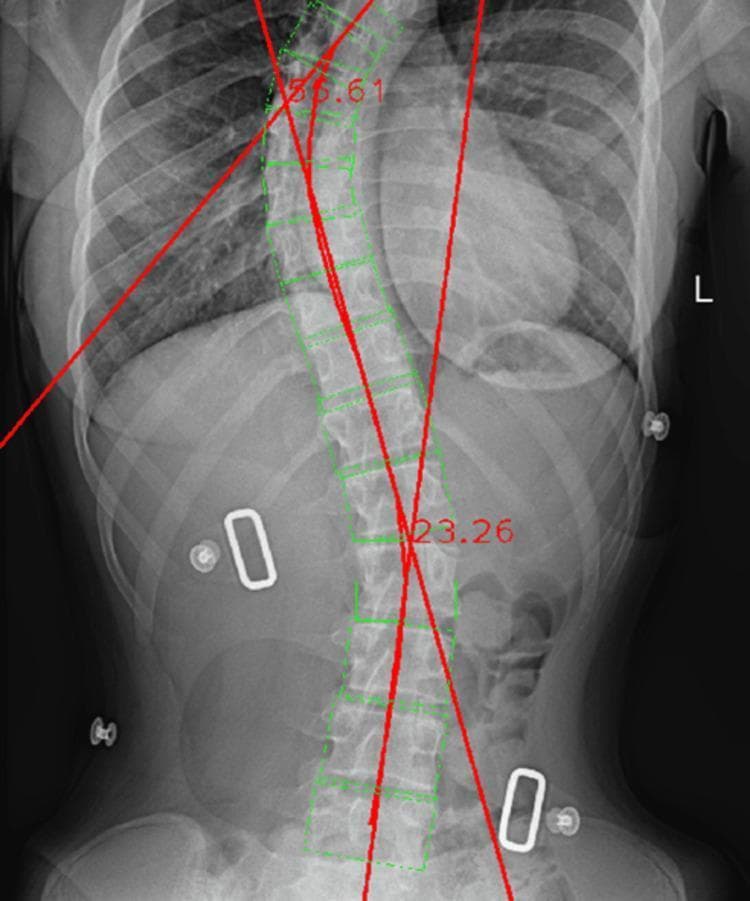 This diagnostic image is an anteroposterior (AP) X-ray of the thoracolumbar spine showing significant scoliotic deformity. The visual content demonstrates an automated Cobb angle measurement performed by clinical software. Green rectangular boxes are overlaid on individual vertebral bodies from the upper thoracic to the lower lumbar region, mapping their anatomical margins. A red polyline follows the central spinal midline, highlighting lateral curvature. Two sets of intersecting red tangent lines are visible: one in the upper thoracic region measuring an angle of 36.61 degrees, and another in the lumbar region measuring 23.26 degrees. These measurements identify a double-curve pattern consistent with combined thoracic and lumbar scoliosis. The vertebral bodies show visible rotation and tilting, particularly at the apex of the curves. The software tools illustrated are used for objective spinal deformity assessment and classification in orthopedic and radiological settings.