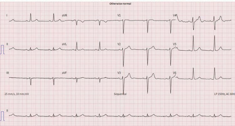 A standard 12-lead electrocardiogram (ECG/EKG) displayed on a red grid background with calibration settings of 25 mm/s and 10 mm/mV. The leads are organized in a four-column by three-row layout (I, II, III; aVR, aVL, aVF; V1, V2, V3; V4, V5, V6) with a continuous rhythm strip of Lead II at the bottom. The tracing shows a normal sinus rhythm with clearly identifiable P waves, narrow QRS complexes, and upright T waves in most leads. A notable diagnostic finding is left axis deviation, characterized by a predominantly positive QRS complex in lead I and a negative QRS complex in leads II, III, and aVF. Annotations on the tracing include 'Otherwise normal' at the top, 'Sequential' in the center, and filter settings (LP 150Hz, AC 60Hz) in the bottom right corner. This image serves as a clinical example of an ECG tracing used for assessing cardiac electrical activity and axis orientation in cardiovascular medicine.