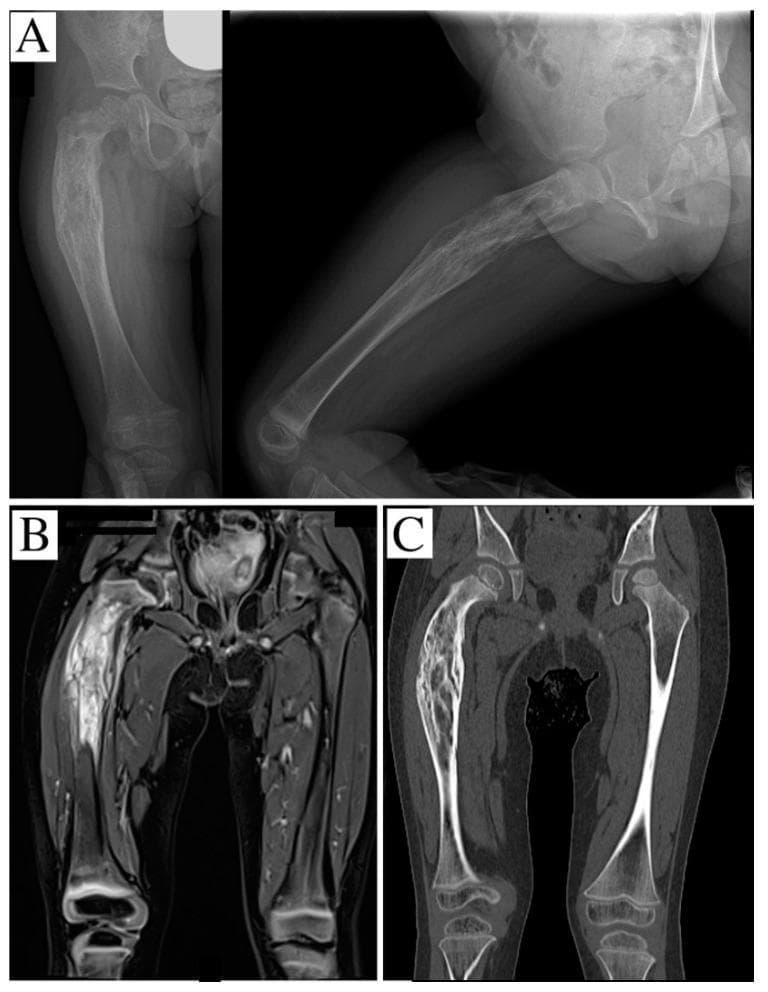 This composite of diagnostic images demonstrates a primary malignant bone tumor, specifically Ewing's sarcoma, in the right femur of a pediatric patient. Panel A displays plain radiographs (anteroposterior and lateral views) showing an aggressive osteolytic lesion in the proximal and middle third of the femoral shaft. Key findings include a pathological bowing deformity and a classic 'onion-skin' periosteal reaction, indicating rapid, multilayered new bone formation. Panel B is a STIR-weighted coronal MRI reconstruction showing high signal intensity, which evidences significant intramedullary marrow infiltration and extensive peritumoral soft tissue edema. Panel C provides a coronal CT scan, highlighting geographic osteolysis and significant cortical thinning/disruption. These images collectively illustrate the radiographic hallmarks of aggressive musculoskeletal neoplasms: permeative bone destruction, exuberant periosteal response, and soft tissue involvement. The preservation of the growth plates is visible, though the lesion extends near the proximal physis. This material is suitable for advanced medical education regarding orthopedic oncology and pediatric radiology.