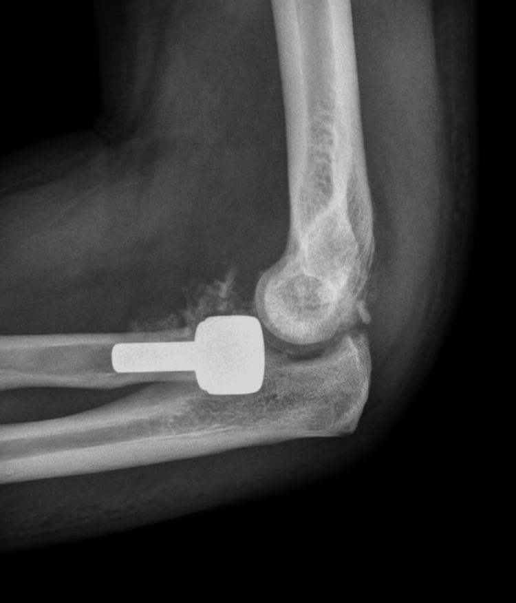 This lateral view X-ray of the elbow shows a radial head prosthesis following a complex injury, likely a 'terrible triad' injury. The imaging reveals a metallic, radiopaque radial head prosthesis consisting of a rounded articular head and a cylindrical intramedullary stem. The primary finding is a posterior subluxation of the radial head prosthesis; the prosthetic head is displaced posteriorly and is no longer articulating correctly with the capitellum of the distal humerus. While the ulnohumeral joint appears to maintain a degree of congruence, the malalignment of the radial component signifies joint instability. Additional soft tissue shadowing or heterotopic ossification may be present anterior to the joint space. This image demonstrates a significant postoperative complication, specifically prosthetic instability and subluxation, which is critical for medical students and orthopedic residents to recognize as a potential failure of stabilization following radial head arthroplasty.