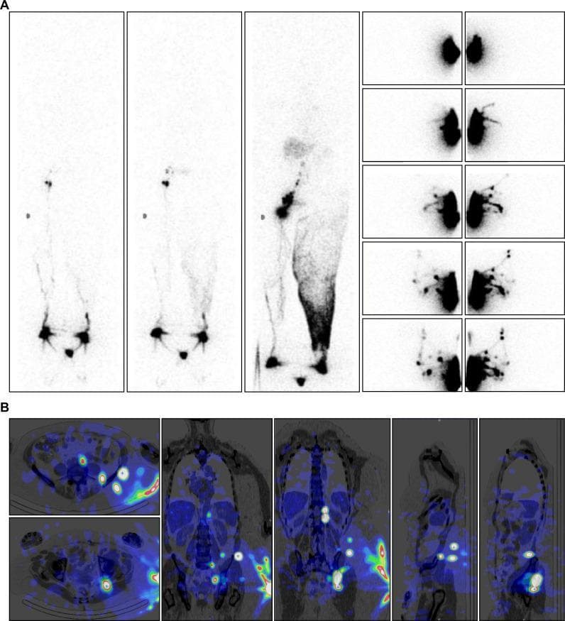 This composite figure displays diagnostic lymphoscintigraphic and SPECT-CT imaging of a 74-year-old female with secondary lower limb lymphedema following inguinal and iliac lymph node dissection.
Panel A (Top): Anterior Whole-Body Scans (WBS) across three phases. Phase 1 (resting) shows normal drainage on the right and limited distal tracer progression on the left. Phase 2 (post-exercise) reveals increased right inguinal nodal activity and collateral vessels above the left ankle. Phase 3 (post-walking) demonstrates extensive dermal backflow on the left extending from the ankle to the groin, without visualizing distinct lymph nodes. Subsequent intradermal gluteal injections (right sub-panels) reveal alternate lymphatic pathways.
Panel B (Bottom): SPECT-CT fusion images in transverse, coronal, and sagittal planes. These images localize radiocolloid uptake to deep collateral pathways, identifying intergluteal lymphatic vessels and intercalated nodes near the iliac crest and paravertebral regions. The imaging highlights the clinical significance of identifying deep lymphatic drainage when superficial inguinal nodes are absent, aiding in the surgical planning for lymph node-to-vein anastomosis or targeted physical therapy.