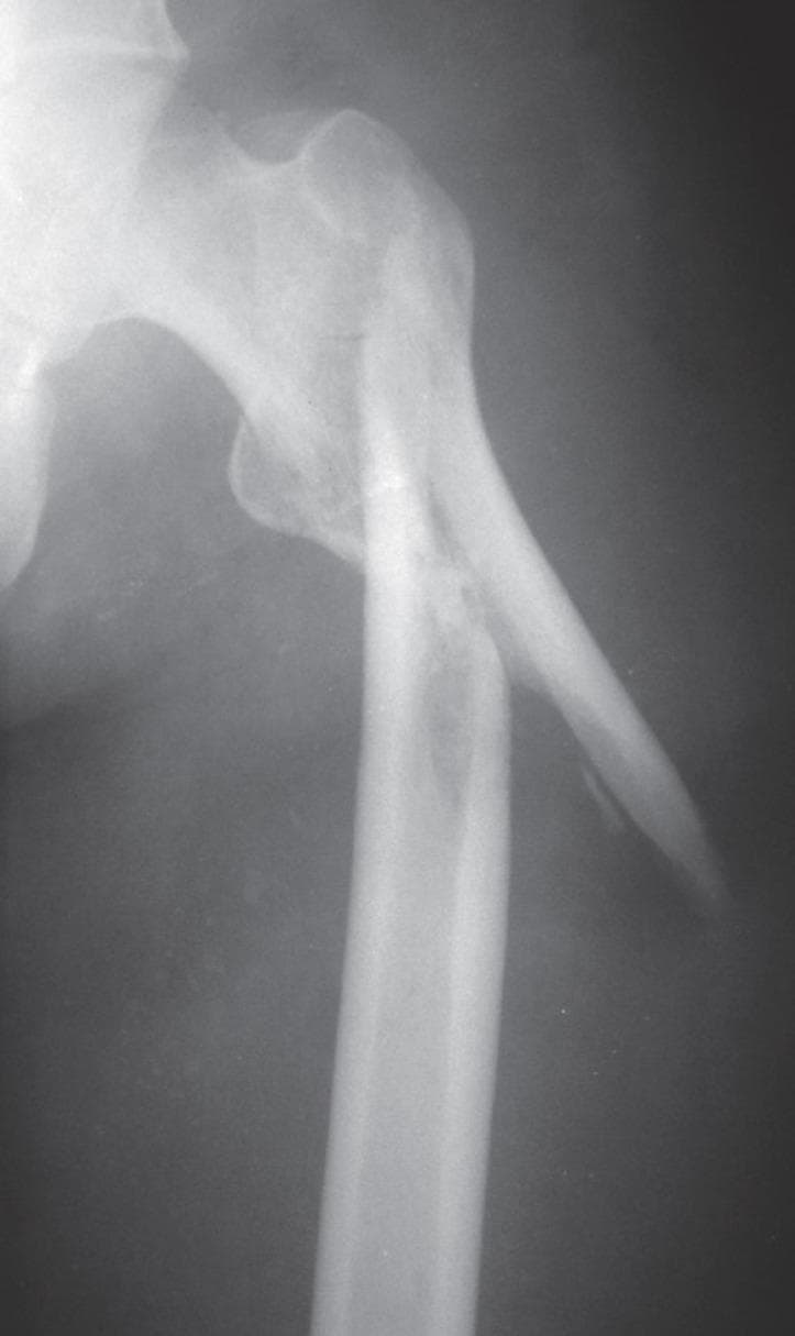 Anteroposterior (AP) radiograph of the proximal femur showing a complex subtrochanteric fracture. The fracture is located distal to the lesser trochanter and exhibits a comminuted or spiral pattern with significant displacement and angulation. A large, sharp cortical spike is visible extending laterally from the proximal fragment. The distal femoral shaft is displaced laterally and superiorly relative to the proximal fragment. Notable for educational purposes is the absence of bridging callus formation three months post-injury, despite the rounding of fracture edges, which indicates a delayed union or non-union. The image demonstrates the limitations of prolonged skeletal traction in achieving anatomical reduction for subtrochanteric femoral fractures. The anatomy shown includes the femoral head, neck, greater trochanter, and the proximal femoral diaphysis.