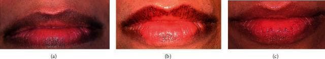 This set of clinical photographs documents the progression of lip depigmentation treatment using an Er,Cr:YSGG laser. Image (a) shows the 'before' state, characterized by significant dark melanin hyperpigmentation concentrated along the vermillion border and the body of both the upper and lower lips. Image (b) represents the immediate post-procedural phase, exhibiting a 'mild crust' effect. This crusting is dark red and textured, localized primarily along the upper vermillion border, accompanied by generalized erythema and mild swelling of the labial mucosa. Image (c) displays the 'after healing' result, demonstrating successful melanin reduction. The lips show a more uniform, natural pink coloration with a smooth surface texture and the absence of scarring or residual hyperpigmentation. This series illustrates the clinical efficacy of laser resurfacing for aesthetic lip depigmentation and the typical transient inflammatory response (crusting) during the 14-day healing window.