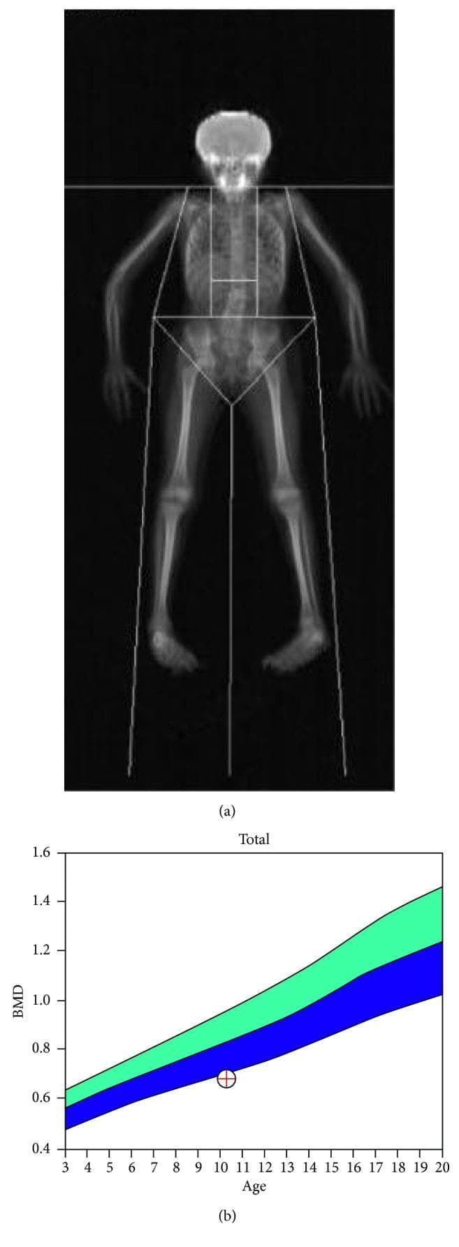 This dual-energy X-ray absorptiometry (DEXA) scan report includes a whole-body skeletal image and a corresponding bone mineral density (BMD) graph. (a) The clinical image displays a full-body scan of a pediatric patient in the anterior-posterior view, with white geometric boundaries delineating standard regions of interest for density measurement, including the head, trunk, and extremities. The bones are visualized in grayscale, where varying intensities correspond to mineral content. (b) The lower panel presents a quantitative BMD graph for total body evaluation. The x-axis represents age (3–20 years) and the y-axis represents BMD (g/cm²). Color-coded percentile bands (green and blue) denote the age-matched reference range for a healthy population. A specific data point, marked by a crosshair at approximately age 11, sits significantly below the expected mean, correlating with a Z-score of -2.4. This diagnostic finding is characteristic of secondary osteoporosis, potentially related to chronic corticosteroid use or systemic conditions such as psoriasis. This educational material is suitable for understanding bone densitometry interpretation and pediatric metabolic bone disease.