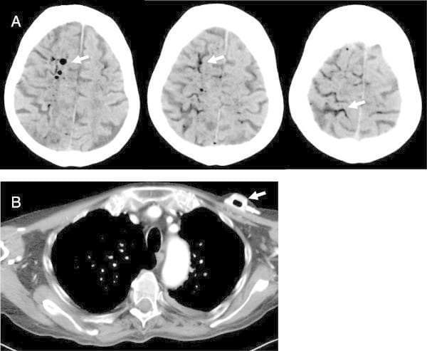 This composite diagnostic image illustrates a clinical case of cerebral air embolism. Panel A consists of three sequential native axial CT scans of the brain at the level of the upper convexities. Multiple focal, hypodense (dark) inclusions representing air are visible within the subarachnoid spaces and sulci, indicated by white arrows. The distribution of these air bubbles is markedly asymmetrical, with a higher concentration localized in the right hemisphere. Panel B is an axial CT scan of the thorax at the level of the upper mediastinum and shoulder girdle. It demonstrates an implanted port catheter in the subcutaneous tissue of the upper chest. A prominent hypodense air pocket is visible within the lumen of the port reservoir (arrow), suggesting the port as the portal of entry for the iatrogenic air embolism. This imagery is highly relevant for neuro-radiological and emergency medicine education, highlighting the radiological appearance of intravascular or subarachnoid air as a complication of central venous access.