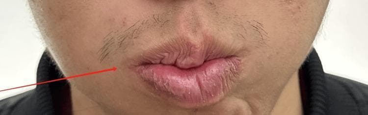 This clinical photograph shows a close-up view of the lower face of a patient with peripheral facial paralysis (Bell's palsy), specifically during a post-treatment evaluation. The image captures the patient attempting to whistle, a maneuver used to assess the function of the orbicularis oris muscle. A prominent red arrow points to the right side of the mouth (anatomical right), highlighting persistent asymmetry. The lips are pursed but deviate toward the left side of the image, indicating residual weakness or impaired motor control on the patient's right side. While the skin texture is similar bilaterally, there is a visible loss of muscle tone and fullness on the affected right side, resulting in an uneven labial seal and distorted philtrum during exertion. This image serves as a clinical demonstration of cranial nerve VII (facial nerve) dysfunction and is used to monitor recovery progress, often graded using the House-Brackmann scale.