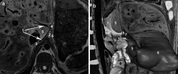 This figure provides a detailed anatomical visualization of the superior recess of the omental bursa (lesser sac) using cross-sectional imaging and 3D reconstruction. Figure (a) is a high-resolution axial cross-section viewed from the inferior aspect, demonstrating the superior recess (1) as it wraps around the caudate lobe of the liver (5). Key anatomical landmarks include the hepatogastric ligament (4) forming the anterior boundary, the hepatic bare area (3) positioned posteriorly, and the gastric bare area (2) located to the left, near the gastric wall (6). Figure (b) presents a 3D sagittal-oblique reconstruction from the right side, illustrating the longitudinal relationship between the superior recess (1), the vestibulum bursae omentalis (10), and the inferior recess (9). The foramen bursae omenti majoris (7) is highlighted as a critical transition point between these spaces. Other visualized structures include the pancreas (8) and the gastric wall (6). These images serve as educational resources for understanding the complex peritoneal folds and potential spaces for fluid collection in the upper abdomen, relevant for surgical planning and radiological interpretation of conditions like acute pancreatitis.