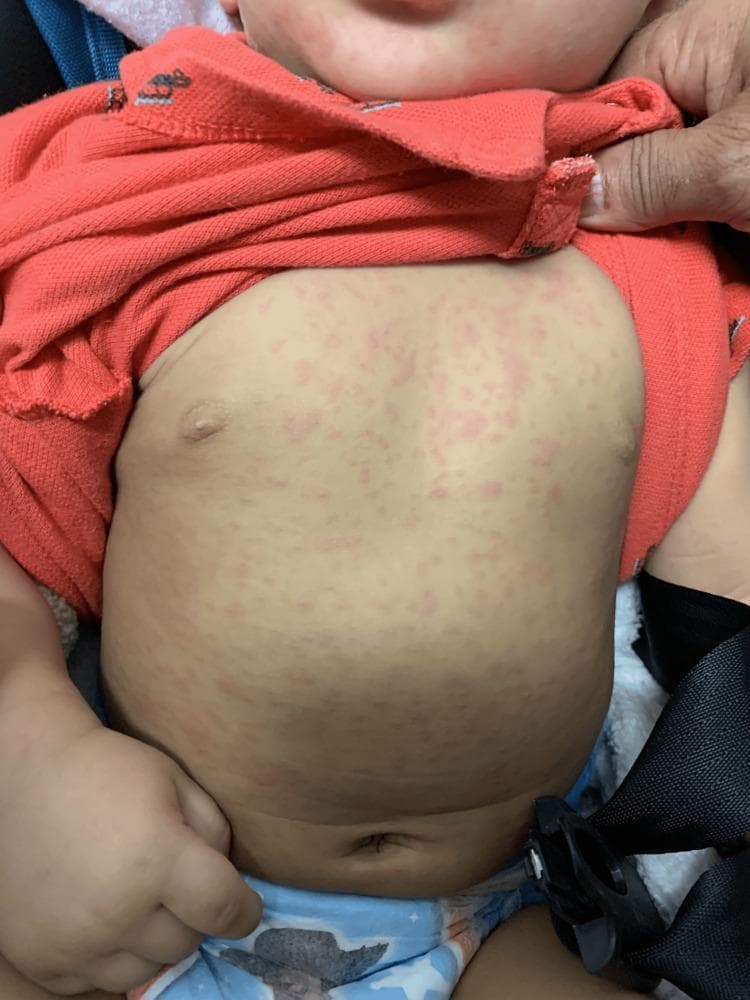 A clinical photograph of an infant's torso and lower face demonstrating a classic exanthem. The image shows a diffuse, erythematous, macular rash consisting of small, discrete, pale-pink macules. The lesions are primarily distributed centrally on the chest and abdomen with extension towards the neck and proximal extremities. The rash appears non-scaling and non-confluent, with clear areas of skin visible between the lesions. This presentation is characteristic of the defervescence rash associated with Roseola Infantum (Exanthema Subitum), typically caused by Human Herpesvirus 6 (HHV-6). The educational focus is on identifying the morphology and centrifugal distribution of viral exanthems in the pediatric population following a febrile episode.