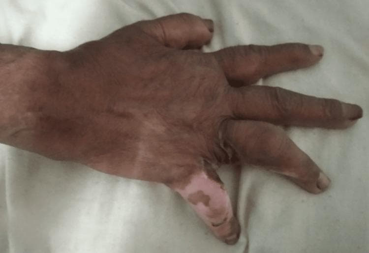 This clinical photograph displays the dorsum of a hand with significant post-burn sequelae and surgical interventions. The image illustrates a second-degree burn injury complicated by wound contracture, particularly affecting the fourth (ring) and fifth (little) digits. There is visible evidence of split skin grafting, characterized by well-demarcated patches of hypopigmented and differently textured skin on the dorsum of the hand and the fourth digit, contrasting with the patient's natural darker skin tone. The fourth and fifth digits show restricted extension and an inward pulling toward the palm, indicative of burn-induced contracture. The skin appears dry, with scattered pigmentation and scarring in the interdigital space between the affected fingers. This visual serves as an educational example of plastic and reconstructive surgery outcomes for thermal injuries, demonstrating the appearance of skin grafts and the clinical manifestation of post-burn functional impairment in the hand.