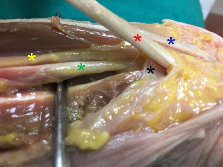 Anatomical Dissection: This clinical photograph depicts a deep dissection of the human wrist joint, focusing on the contents of the carpal tunnel and surrounding structures. The flexor retinaculum (black asterisk) is identified as a fibrous band forming the roof of the carpal tunnel. Labeled tendons include the flexor carpi radialis (red asterisk), which appears as a robust, white rope-like structure, and the more slender, string-like palmaris longus tendon (blue asterisk). The median nerve (yellow asterisk) is clearly visible with a characteristic yellowish hue, positioned superficially relative to the deeper flexor pollicis longus tendon (green asterisk). A surgical probe is used to retract tissues, highlighting the spatial relationship between these neurovascular and tendinous structures. This specimen serves as an educational reference for upper limb anatomy, demonstrating the clinical significance of carpal tunnel anatomy and the relative positions of structures vulnerable to compression or surgical intervention.
