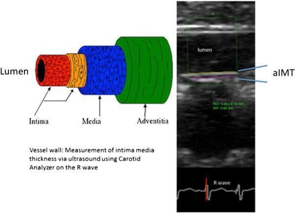 This composite educational graphic illustrates the assessment of aortic intima-media thickness (aIMT) in pediatric clinical research. On the left, an anatomical diagram of a blood vessel cross-section details the vascular wall architecture: the lumen (center), the Tunica Intima (red), the Tunica Media (blue), and the Tunica Adventitia (green). On the right, a longitudinal B-mode ultrasound image of an infant aorta demonstrates the clinical application of this model. The ultrasound features a green region of interest (ROI) where semi-automated edge-detection software identifies the far-wall interfaces of the intima and media. The specific 'aIMT' measurement is highlighted between these layers. At the bottom of the ultrasound panel, a synchronized electrocardiogram (ECG) trace with a highlighted R-wave indicates that measurements are gated to end-diastole for consistency. This material is designed to teach diagnostic imaging techniques used for evaluating early vascular changes and cardiovascular risk markers in infant populations.