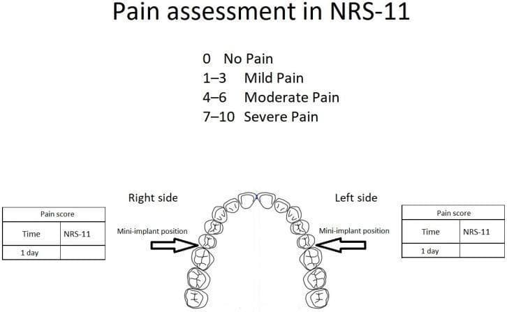 This infographic illustrates the methodology for orthodontic pain assessment using the NRS-11 scale following mini-implant placement. The top section defines the Numeric Rating Scale (NRS-11) categories: 0 (No Pain), 1–3 (Mild Pain), 4–6 (Moderate Pain), and 7–10 (Severe Pain). Central to the figure is an anatomical diagram of the maxillary dental arch. Black arrows indicate the bilateral 'Mini-implant position' in the posterior region, specifically between the second premolars and first molars. Flanking the anatomical diagram are two data entry tables labeled 'Pain score' for the 'Right side' and 'Left side.' Each table contains columns for 'Time' (specified as 1 day post-treatment) and 'NRS-11' score. This layout is designed for a clinical study comparing postoperative pain levels between a treatment group and a control group in orthodontic procedures involving bone-anchored devices.