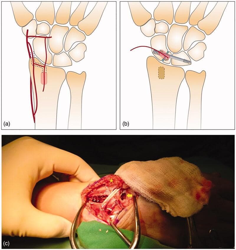 This composite visual represents a surgical technique for treating scaphoid nonunion using a vascularized bone graft (VBG) and scapholunate (SL) screw fixation. Panels (a) and (b) are anatomical diagrams of the dorsal wrist. Panel (a) illustrates the anatomy of the 2,3 intercarpal supraretinacular artery (ICSRA) and the designated donor site on the distal radius for graft harvesting. Panel (b) shows the postoperative schematic where a headless compression screw stabilizes the scapholunate joint, and the vascularized bone graft is inset into the scaphoid. Panel (c) is an intraoperative clinical photograph showing the surgical field through a dorsal approach. An asterisk marks the harvested 2,3 ICSRA pedicled bone graft, still attached to its vascular supply. A yellow arrow points to the recipient cavity prepared in the scaphoid bone at the nonunion site. Self-retaining retractors are used to expose the carpal bones and distal radius. This educational material demonstrates orthopedic microvascular techniques, specifically the use of pedicled grafts for scaphoid reconstruction when vascularity is compromised.