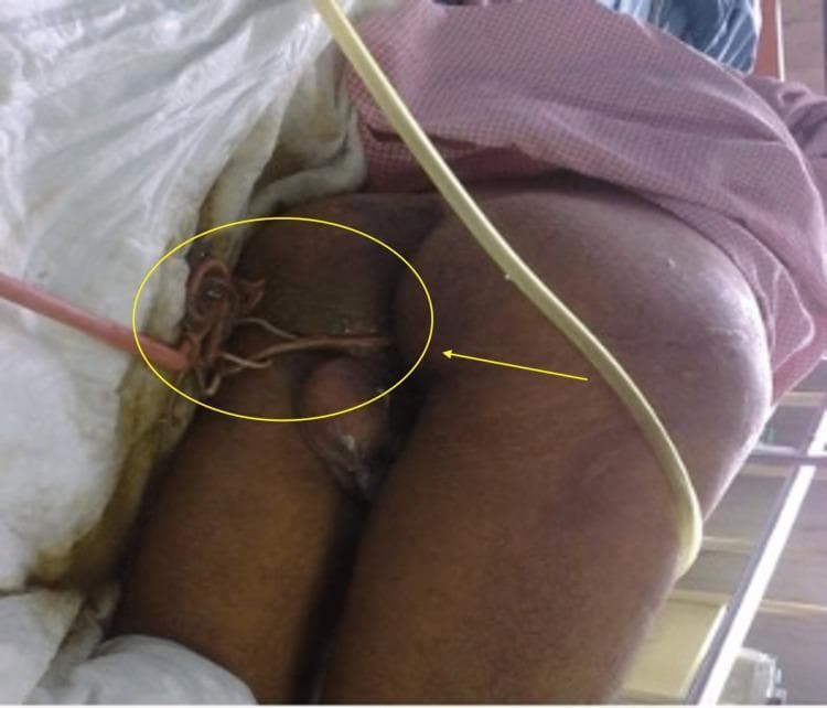 Clinical photograph of a patient in a medical setting demonstrating a severe helminthic infestation. The image captures the perineal and gluteal region, where several live, light-brown, tubular parasites, identified as Ascaris lumbricoides, are seen emerging from the anal opening. The worms exhibit a cylindrical, elongated morphology and appear coiled or intertwined. The primary area of focus is demarcated by a yellow circle and indicated by a yellow arrow. Surrounding medical context includes clinical draping, a pinkish flexible tube (possibly a urinary catheter or drainage line), and a thicker yellow tube running across the patient's right thigh. This visual demonstrates the clinical manifestation of ascariasis, specifically the spontaneous migration of adult nematodes from the gastrointestinal tract during systemic illness. The finding is relevant for infectious disease and gastroenterology specialties, illustrating complications of heavy worm burden and intestinal migration.