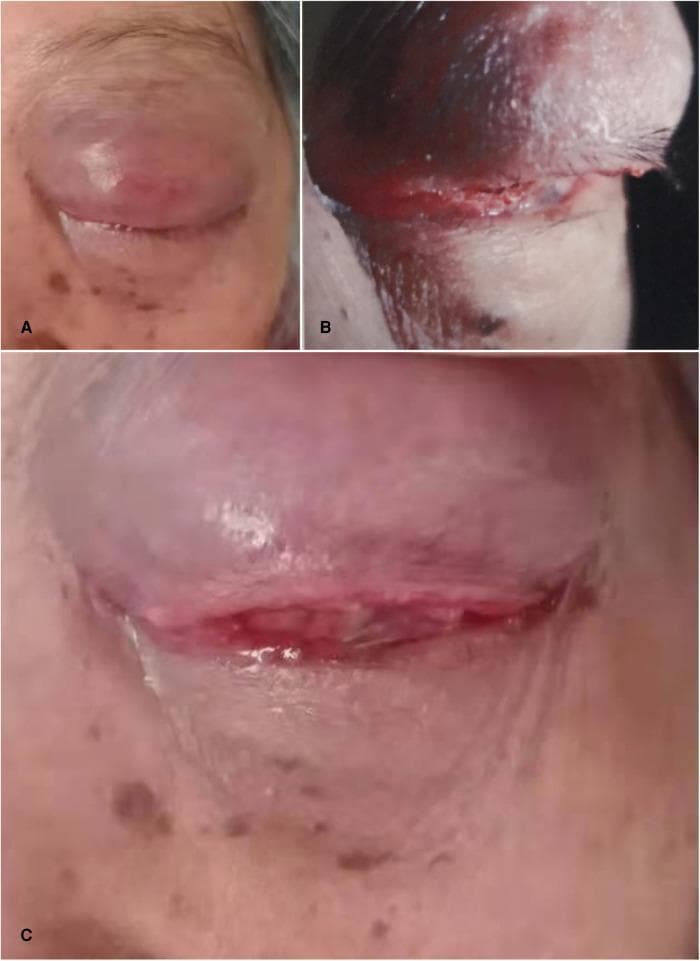 This set of clinical photographs illustrates severe ocular pathology in the left eye, later confirmed as orbital squamous cell carcinoma. Panel A shows significant erythematous swelling of the left upper eyelid with the loss of normal skin folds (dermatoglyphs), leading to mechanical ptosis. Panel B provides a profile view of a large, infiltrating mass measuring approximately 30 mm x 20 mm within the upper eyelid; the lesion exhibits ill-defined boundaries, firm texture, and overlying skin hyperpigmentation. Panel C demonstrates secondary ocular involvement including severe bulbar conjunctival chemosis (edema), conjunctival hyperemia, and corneal conjunctivalization. These findings represent advanced orbital malignancy with massive space-occupying effects, resulting in globe compression and severe secondary glaucoma (46.5 mmHg). The images provide high-level educational value for ophthalmology and oncology specialties regarding the clinical presentation of aggressive orbital adnexal tumors.